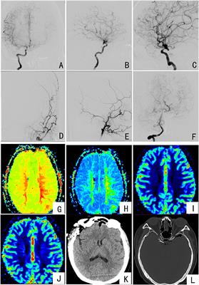 Case Report: The Different Fates of Three Aneurysms: Diagnosis and Treatment Strategies for Unruptured Intracranial Aneurysms With Other Intracranial Diseases